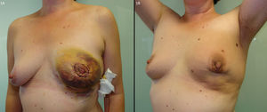 A) Paciente con hematoma postoperatorio tras técnica de round-block. B) Retracción en el polo inferior tras irradiación de la mama.