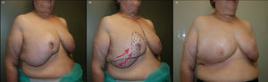 A) Paciente con necrosis grasa tras mamoplastia oncorreductora en gigantomastia. B) Planificación de resección y remodelación de la mama derecha mediante un patrón vertical. C) Resultado tras la mamoplastia reductora.