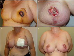 A) Paciente con necrosis superficial de aréola de la mama izquierda tras mamoplastia vertical. B y C) Se realizó movilización de la escara, limpieza de la herida y colocación de sistema portátil de vacío para la epitelización de la herida. D) Resultado tras cura con vacío.