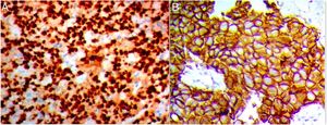 figure 1 showed (A) strong nuclear expression of Snail-1 in high grade invasive duct carcinoma (IHC ×400) and (B) strong membranous expression of Claudin-4 in high grade invasive duct carcinoma.