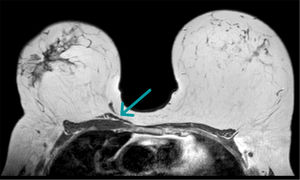 Caso clínico 3, músculo esternalis marcado con flecha en TAC preoperatoria.