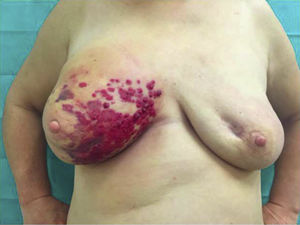 Imagen objetivada en consulta externa. Lesiones cutáneas violáceas en cuadrantes internos de mama derecha, de rápida evolución.