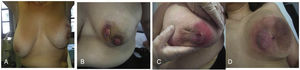 Imágenes clínicas de alguna de las pacientes previa al tratamiento con MFM, en el que observamos el nódulo doloroso con abscesificación y fistulización a piel de las lesiones unilaterales que afectaban a la mama.