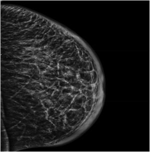 Mamografía del seno izquierdo que muestra edema cutáneo difuso.