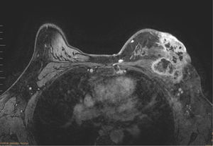 Resonancia magnética de mamas. Múltiples áreas en relación con necrosis, contacta ampliamente con pared costal con datos de infiltración muscular, engrosamiento e hipercaptación de la piel de los cuadrantes externos, así como retracción del pezón. Múltiples adenopatías axilares ipsilaterales.