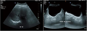 Ultrasonido abdominopélvico que muestra ausencia total de riñón derecho y útero.