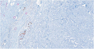 Técnica inmunohistoquímica p63 – miosina: El componente teñido de marrón corresponde al p63 y el rojo a la miosina. La ausencia de células basales en el componente tumoral tanto intraluminal como de la pared del quiste confirma el carácter infiltrante de la lesión (control interno positivo en vasos sanguíneos y parénquima no tumoral adyacente).
