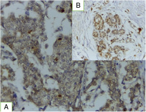 (A) Low expression of TRL5 in infiltrating duct carcinoma (ABCx400). (B) Positive expression of TRL5 in normal adjacent breast tissue (ABCx100).