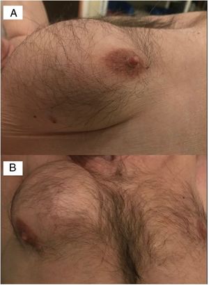 A) Fotografía del plano lateral. B) Plano anterior de una voluminosa tumoración mamaria derecha.