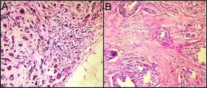 Collagenous stroma with low TILs (<10%) in invasive breast carcinomas of NST (Hematoxylin–Eosin stain (A) ×40, (B) ×200).