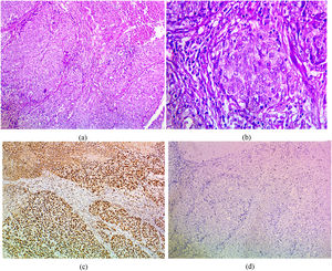 (a) IDC medullary subtype showing syncytial growth pattern (H&E 100×), (b) large and pleomorphic malignant cells with vesicular cytoplasm and surrounded by lymphocytic infiltrates (H&E 400×), (c)IDC medullary subtype showing strong positive nuclear PELP1 expression (IHC 100×), (d) IDC medullary subtype showing negative GATA3 expression (IHC 100×).