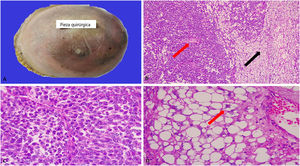 A) Pieza quirúrgica de mastectomía. La piel presenta eritema y nódulos de permeación tumoral. B) Transición del tumor entre el componente epitelioide (flecha roja) y el componente liposarcomatoso (flecha negra). H/E, 10 x. C) El componente epitelioide estaba compuesto por células poligonales con núcleos atípicos y abundantes figuras de mitosis. H/E, 40x. D) La flecha roja muestra un lipoblasto caracterizado por núcleos atípicos, hipercromáticos, irregulares y citoplasmas vacuolados. H/E, 40x.