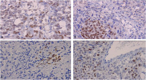 Estudio de inmunohistoquímica. A) Positividad para p63 en las células tumorales. B) Positividad para p40 en las células tumorales. C) Positividad para CK34BetaE12 en las células tumorales. D) Índice de proliferación celular con Ki67 estimado en un 40%.