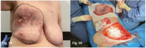 A) Delineación preoperatoria de la pieza a resecar. B) Mastectomía de limpieza.