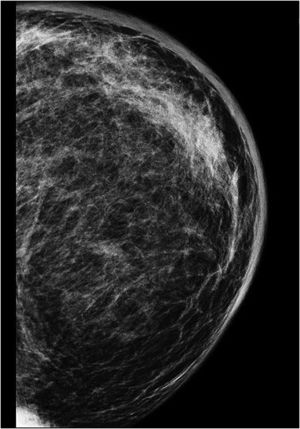 Mamografía craneocaudal de la mama izquierda.