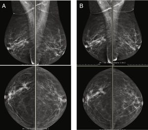 Imágenes oblicuas medio-laterales y craneocaudales de ambas mamas, que se obtuvieron de la misma paciente con 24 h de diferencia. A) mamografía digital de campo completo. B) Imagen de baja energía de la CEM.