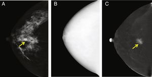 Examen típico de la CEM (solo se muestra la vista cráneo-caudal derecha), que consiste en una imagen de baja energía (A), alta energía (B) y recombinada (C). En la imagen de baja energía se observa una imagen sospechosa, que se realza claramente en la imagen recombinada. El tumor capta el medio de contraste debido a su neovascularización. La histopatología mostró que era un carcinoma ductal invasivo. La imagen de alta energía (B) no es útil para fines de diagnóstico, pero se utiliza para la construcción de la imagen recombinada.