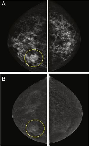 Fibroadenoma en el cuadrante inferior interno de la mama derecha. La lesión era palpable en el examen clínico. A) Imágenes de baja energía del estudio CESM donde se puede ver el nódulo. B) Imagen recombinante que muestra un patrón de realce del área sospechosa. Sin embargo, la definición de los bordes, la forma redondeada, el bajo grado de captación del medio de contraste y la homogeneidad de la distribución del medio de contraste yodado sugieren la existencia de una lesión benigna.