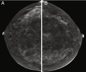 Imágenes recombinantes de un estudio de CESM que muestran una captación múltiple del medio de contraste difusa y bilateral, la cual es difícil de interpretar en una paciente con alta densidad mamaria (ACR grado C). A) Proyección cráneo-caudal de la mama derecha. B) Proyección cráneo-caudal de la mama izquierda. El seguimiento de las imágenes a los 2años no mostró cambios.