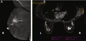 Imágenes de una paciente de 38 años con un carcinoma ductal infiltrante demostrado por biopsia en la mama derecha. A) Imagen oblicua medio-lateral recombinada de la CEM que muestra una masa realzada por el medio de contraste que mide 20,5mm. B) Resonancia magnética de mama con contraste que muestra una masa realzada que mide 21,7mm. La medida histopatológica de la pieza quirúrgica era de 20,3mm.