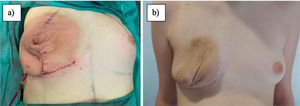 Resultado tras cirugía: a) inmediato tras intervención; b) 3 meses tras intervención (se observa hematoma en resolución e importante exceso de piel, que provoca pliegues principalmente en cuadrantes inferiores e internos de la mama).