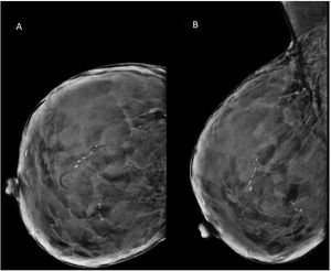 A) Proyección craneocaudal. B) Oblicua mediolateral de la mama derecha. Se identifican calcificaciones agrupadas con morfología lineal y serpiginosa, que siguen trayectos longitudinales sinuosos y vermiculares.