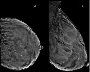 A) Proyección craneocaudal. B) Oblicua mediolateral de la mama izquierda. Se visualizan agrupaciones de calcificaciones dispersas por todo el parénquima mamario, con morfología lineal y serpiginosa en ovillo.