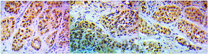 A case of high grade invasive duct carcinoma no special type (TNBC) showing high expression of PARP1 (A), and BRCA1 (B) with positive AR expression (C) (IHC x 400).
