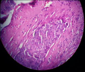 The pathological evaluation of the core needle biopsy showed sheets of atypical cells with large pleomorphic nuclei that invade the fibrotic and desmoplastic stroma revealing the diagnosis of grade II infiltrating ductal carcinoma (IDC) of the breast (Hematoxylin and eosin stain; H&E).