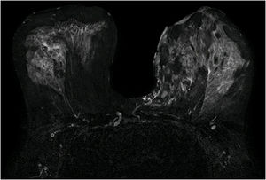 Magnetic resonance with the presence of collections and fistulous trajectories.