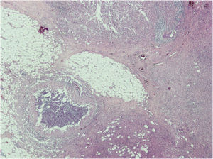 Pathological anatomy: granulomatous lesions superinfected and chronic periductal inflammation.