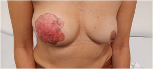 Lesión eritematosa y descamativa en la mama derecha de crecimiento progresivo, de tamaño de unos 12 x 12 cm, de márgenes bien definidos, con pérdida de la proyección del pezón.