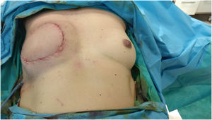 Reconstrucción de la mama derecha mediante un colgajo musculocutáneo de dorsal ancho y cambio de prótesis. Resultado final de la cirugía.