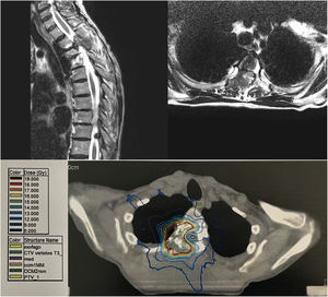 These images represent vertebral metastases before SBRT. a) Sagittal plane MRI before treatment; b) Axial plane MRI before treatment; c) Patient