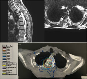 These images represent vertebral metastases before SBRT. a) Sagittal plane MRI before treatment; b) Axial plane MRI before treatment; c) Patient's planning TCimage with dose distribution.
