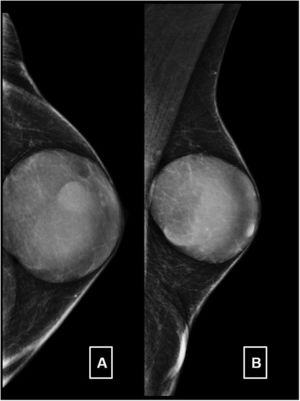 Mamografía izquierda. Proyecciones craneocaudal (A) y oblicua (B) donde se observa una masa de alta densidad ovalada, bien delimitada, posterior al pezón. No se aprecian calcificaciones asociadas.