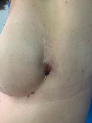 Recurrencia en borde externo del colgajo con las pápulas eritematosas inferiores.