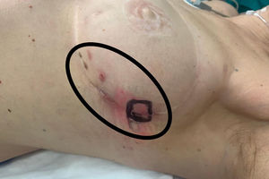 Pieza de ampliación de márgenes.