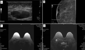 Imagiologic work-up: axillary node on ultrassound, before puncture (A), mammogram of the right breast (B), breast MRI with T1 (C) and T1 – fat saturation (D) techniques.
