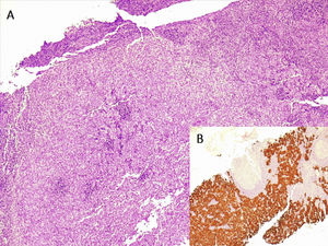Biopsy specimen, collected by needle biopsy of the right axillary adenopathy with large poligonar cells in H&E staining (A). Inset (B) illustrates CK7 positive staining.