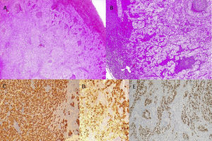 Paraffin sections from the lymph node with metastasis, stained with H&E in A (×2) and B (×5). IHC results included RE(+) (C), GCDFP15(+) (D) and TTF1(−) (E).