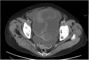 Tomografía con contraste de abdomen corte axial. Se evidencia extensa tumoración abdominopélvica dependiente de anexo izquierdo.