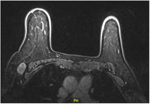 Resonancia magnética de mamas se evidencia adenopatía en región axilar derecha, no lesiones en ambas mamas.