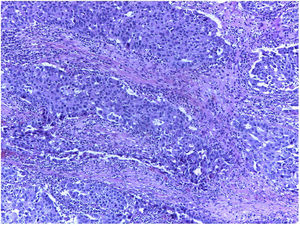 Anexo derecho, imagen con tinción de HE a 10X de aumento, se evidencia tejido ovárico infiltrado por carcinoma seroso de ovario de alto grado.