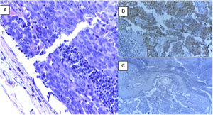 Ganglio axilar izquierdo con metástasis de carcinoma seroso de alto grado con inmunofenotipo compatible con primario de ovario. A) Imagen con tinción de HE a aumento de 40X, ganglio linfático infiltrado por carcinoma seroso de alto grado. B) Células neoplásicas con inmunotinción positiva para PAX-8. C) Células neoplásicas con inmunotinción negativa para GATA 3.