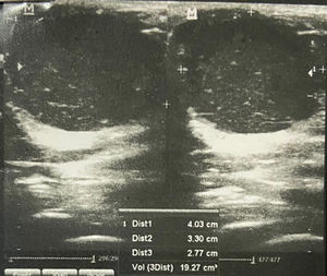 Ultrasonografía de mama derecha.