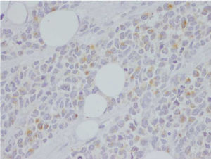 IHC ×40: Cytoplasmic granular staining of tumor cells with chromogranin antibody.