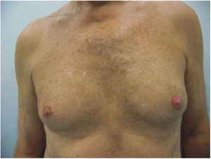 Erosive lesion in left nipple–areola complex in a male patient.