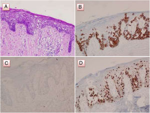 Pathological and immunohistochemical analysis of the PD of the male breast. (A) Infiltration of the epidermis of the nipple by Paget's cells, characterized by hyperchromatic nuclei with prominent nucleoli and clear cytoplasm (H&E). (B) Immunostain for CAM5.2 in Paget cells was positive. (C) Immunostain for cytokeratin-7 in Paget cells was negaive. (D) Immunostain for GATA3 in Paget cells was positive.