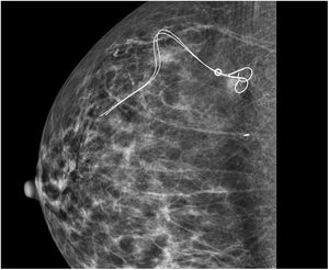Mammographic image showing the metallic marker at the site of breast lesion.